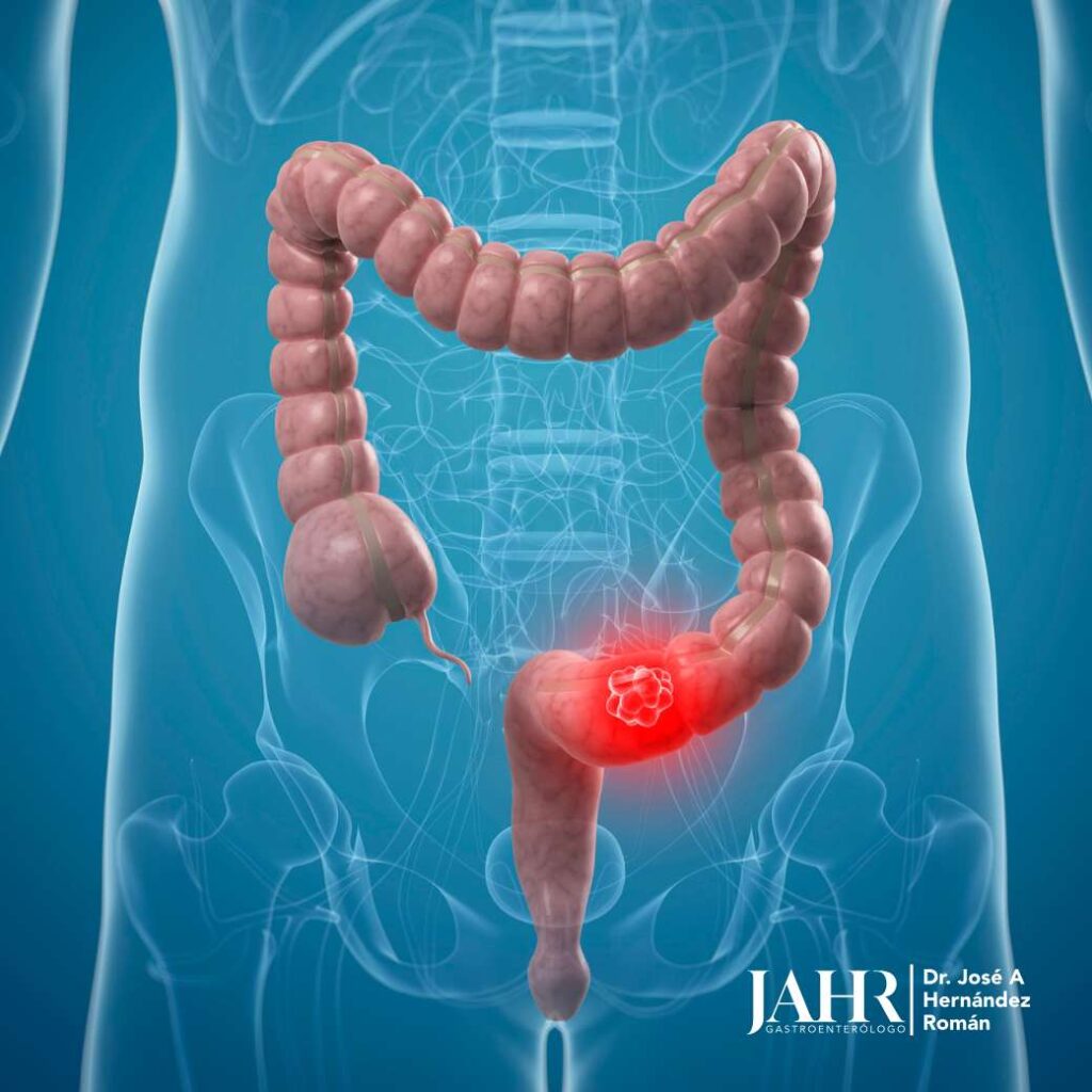 Cáncer de Colon Puerto Rico Gastro Care