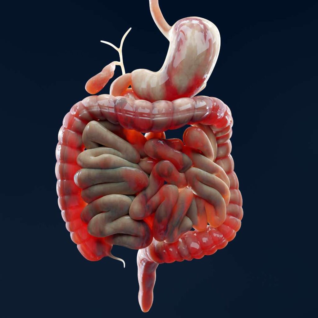 Enfermedad de Crohn
