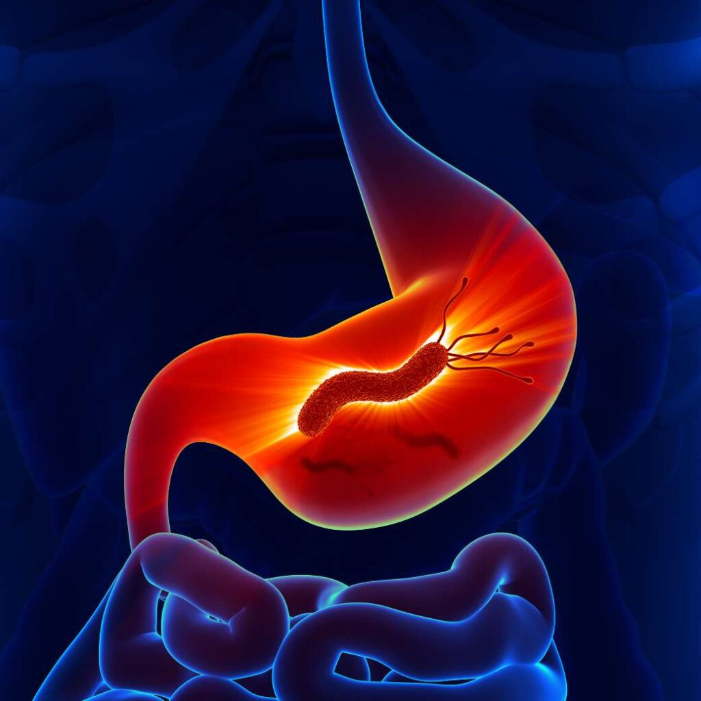 Infección por H. pylori