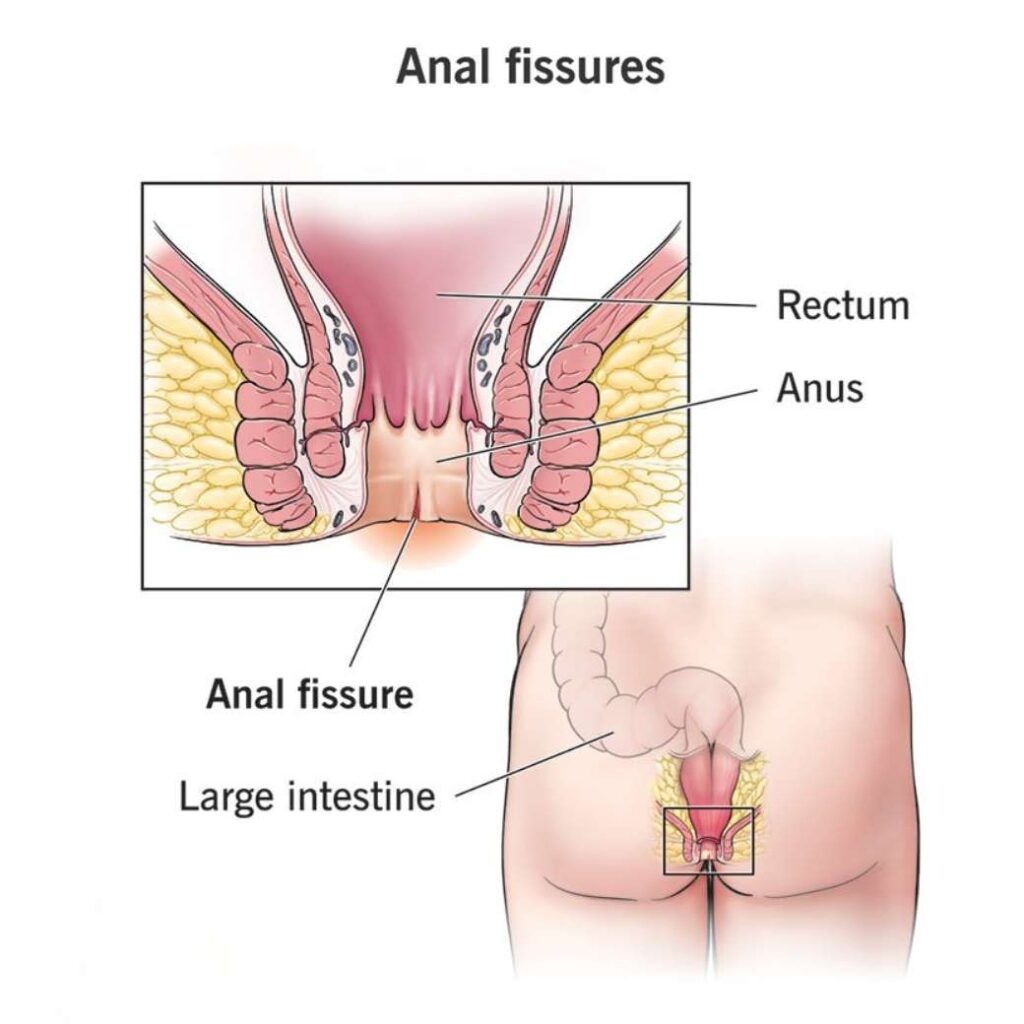 Fisuras anales