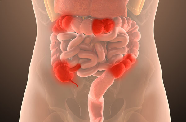 Chron's disease
