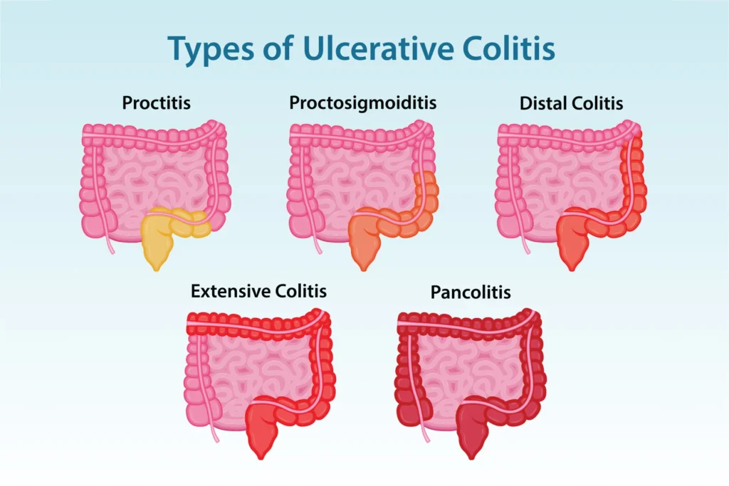 Proctitis