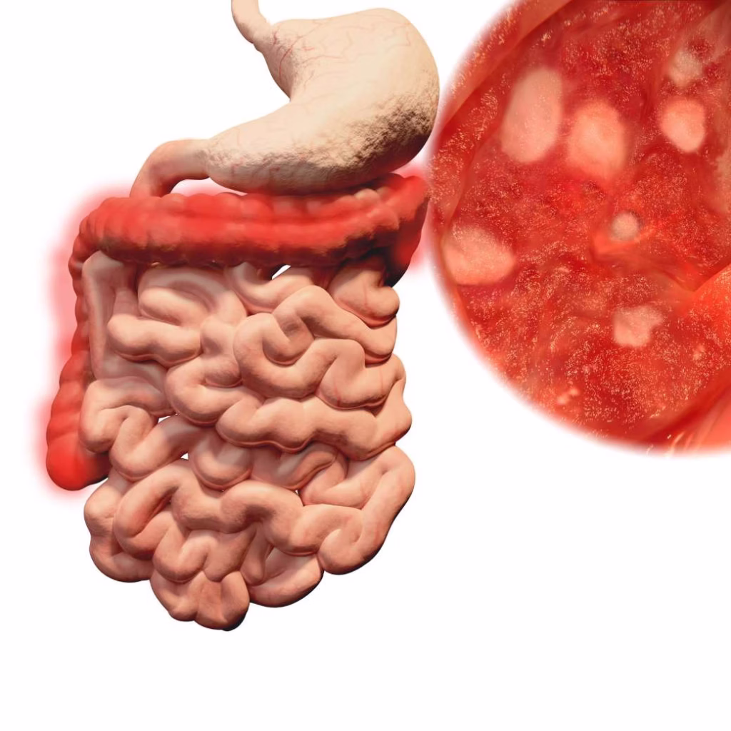 Colitis ulcerosa