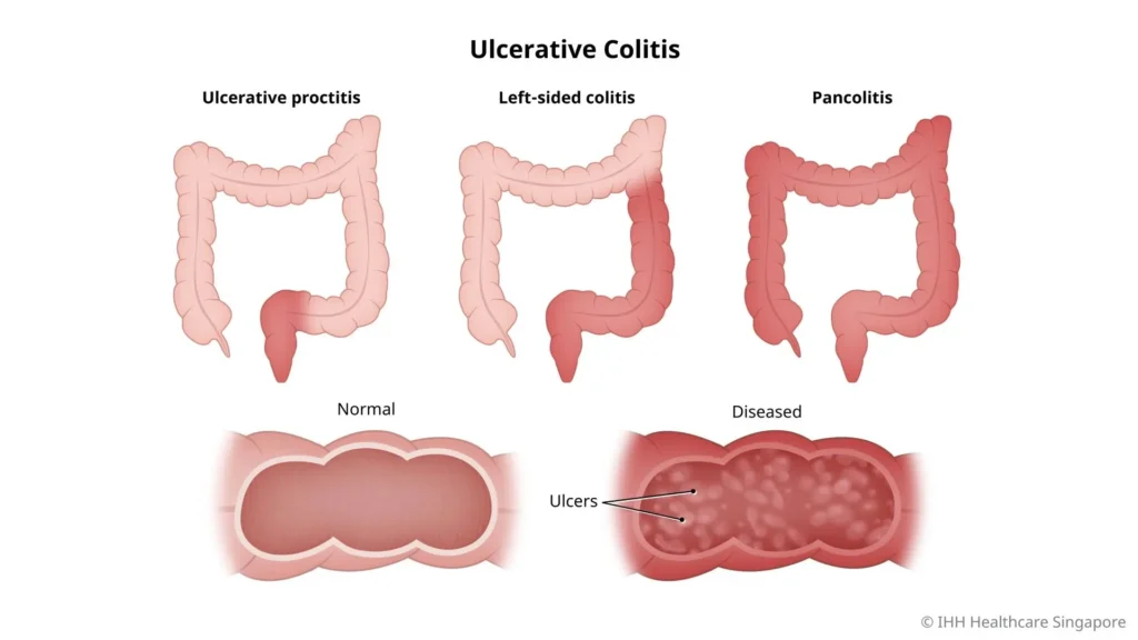 Colitis ulcerosa