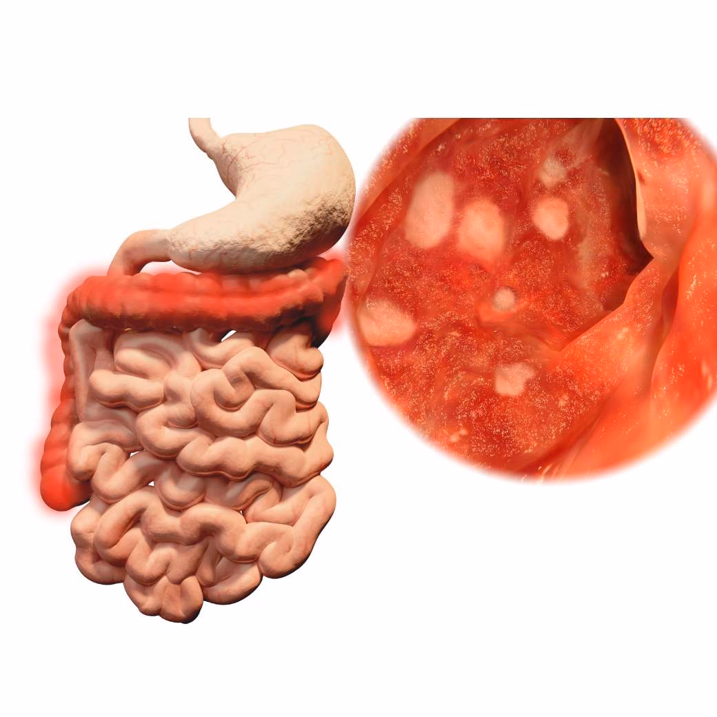 Colitis ulcerosa