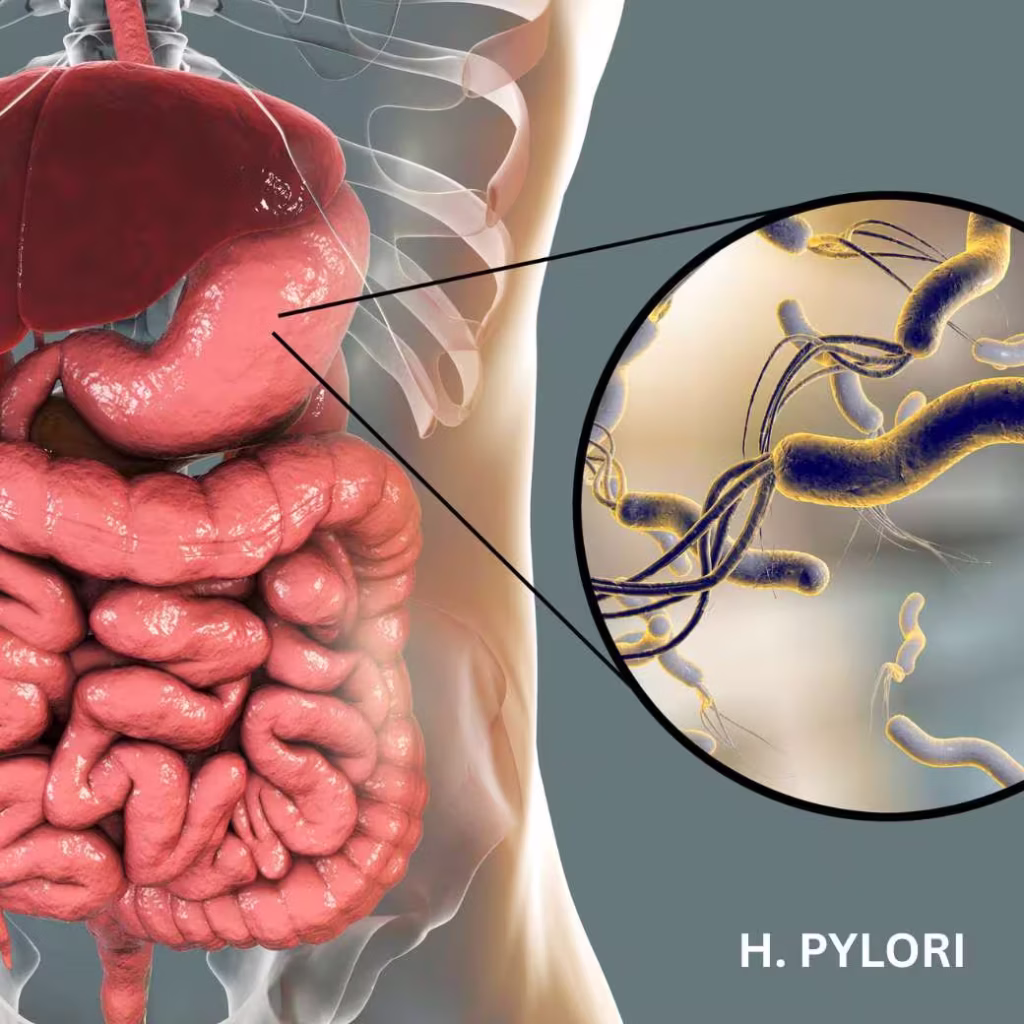H. Pylori