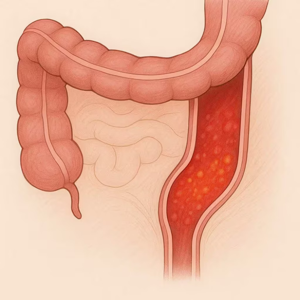 proctitis