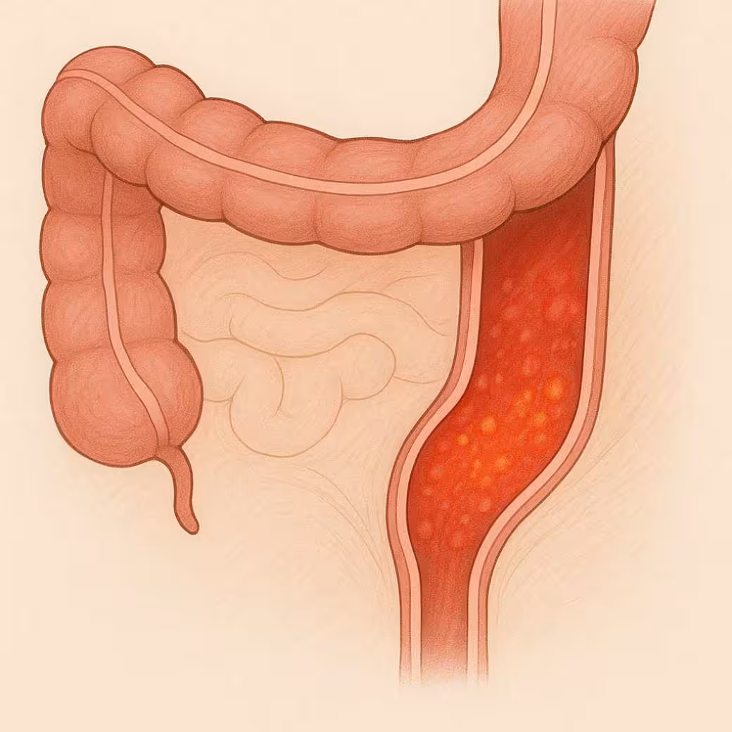 proctitis